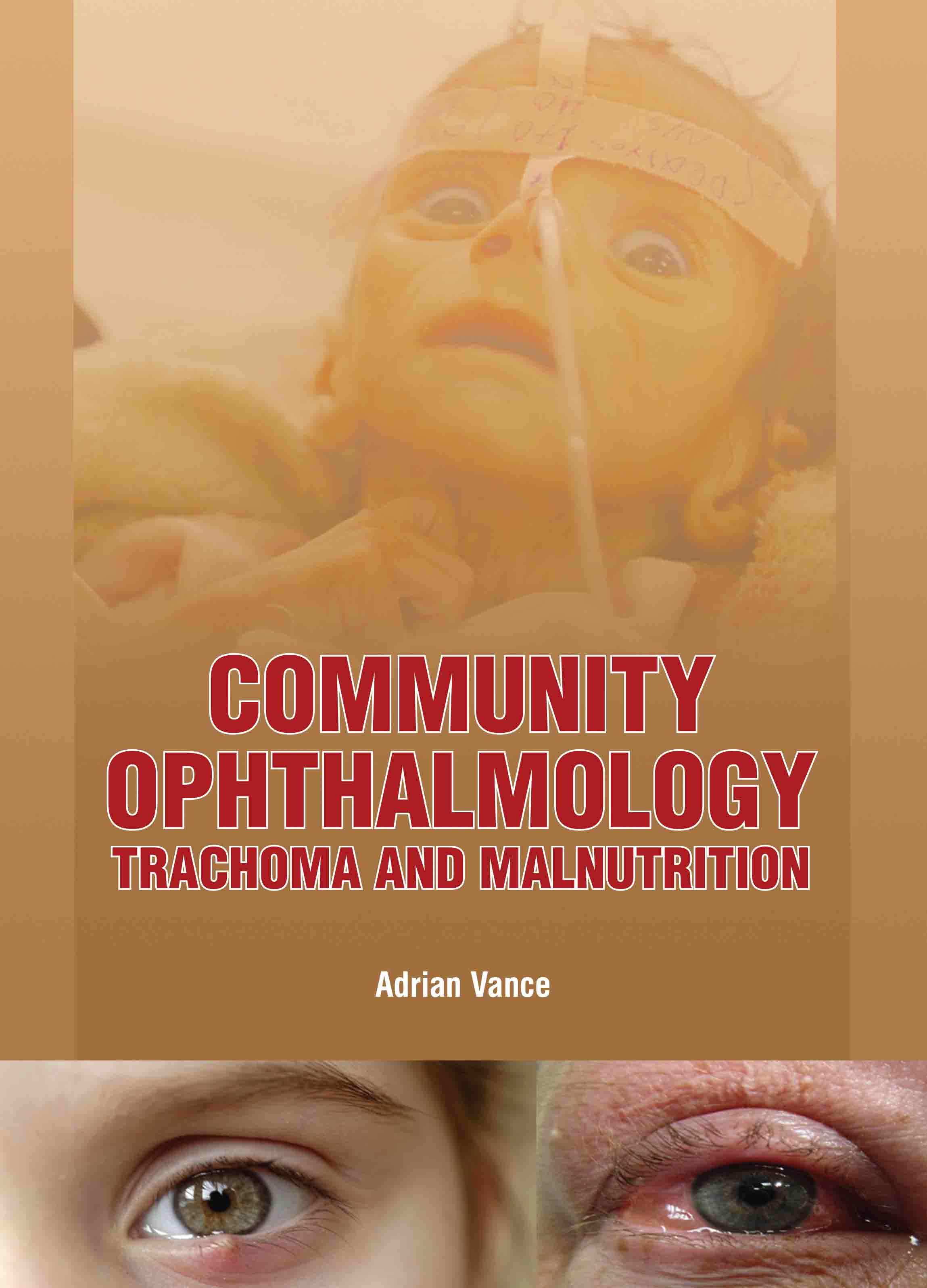 Community Ophthalmology: Trachoma and Malnutrition cover image